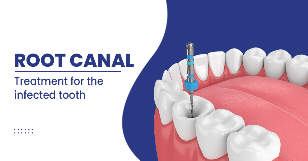 Root Canal Treatment at Vignesh Dental Speciality Center